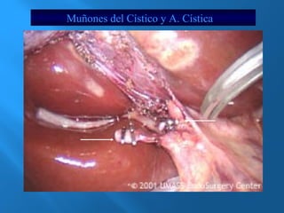 Muñones del Cístico y A. Cística 
 