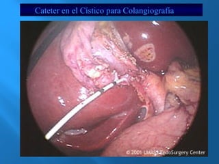 Cateter en el Cístico para Colangiografía 
 