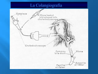 La Colangiografía 
 