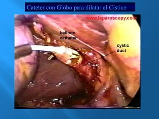 Cateter con Globo para dilatar al Cístico 
 