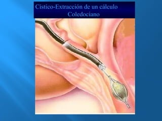 Cístico-Extracción de un cálculo 
Coledociano 
 
