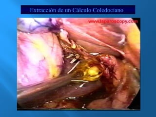 Extracción de un Cálculo Coledociano 
 