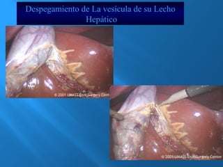 Despegamiento de La vesícula de su Lecho 
Hepático 
 