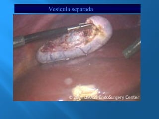 Vesícula separada 
 