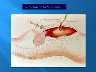 Extración de la Vesícula 
 