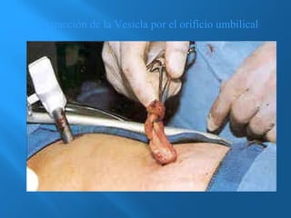 Extracción de la Vesicla por el orificio umbilical 
 