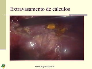 www.sogab.com.br
Extravasamento de cálculos
 
