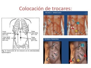 Colocación de trocares:
 