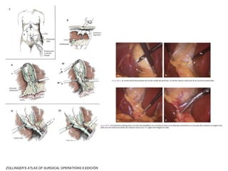 ZOLLINGER’S ATLAS OF SURGICAL OPERATIONS 9 EDICIÓN
 