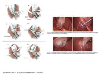 ZOLLINGER’S ATLAS OF SURGICAL OPERATIONS 9 EDICIÓN
 