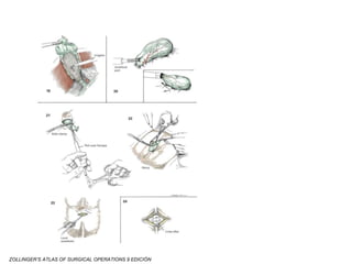 ZOLLINGER’S ATLAS OF SURGICAL OPERATIONS 9 EDICIÓN
 