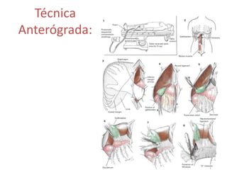 Técnica
Anterógrada:
 
