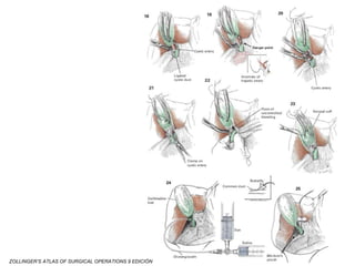 ZOLLINGER’S ATLAS OF SURGICAL OPERATIONS 9 EDICIÓN
 