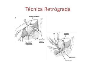 Técnica Retrógrada
 
