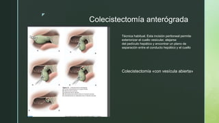 colecistectomia.pptx