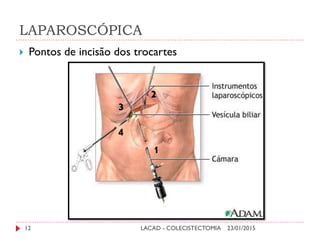 LAPAROSCÓPICA
23/01/2015LACAD - COLECISTECTOMIA12
 Pontos de incisão dos trocartes
1
4
3
2
 