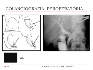 COLANGIOGRAFIA PEROPERATÓRIA
23/01/201517 LACAD - COLECISTECTOMIA
Vídeo
 