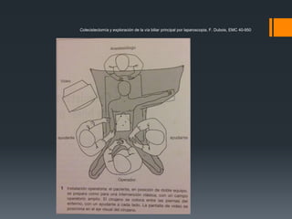 Colecistectomía y exploración de la vía biliar principal por laparoscopia, F. Dubois, EMC 40-950
 