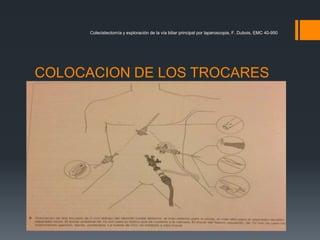 COLOCACION DE LOS TROCARES
Colecistectomía y exploración de la vía biliar principal por laparoscopia, F. Dubois, EMC 40-950
 