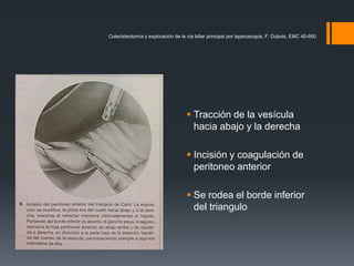 Colecistectomía y exploración de la vía biliar principal por laparoscopia, F. Dubois, EMC 40-950
 Tracción de la vesícula
hacia abajo y la derecha
 Incisión y coagulación de
peritoneo anterior
 Se rodea el borde inferior
del triangulo
 