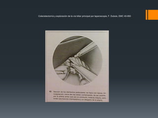 Colecistectomía y exploración de la vía biliar principal por laparoscopia, F. Dubois, EMC 40-950
 