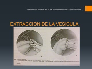 EXTRACCION DE LA VESICULA
Colecistectomía y exploración de la vía biliar principal por laparoscopia, F. Dubois, EMC 40-950
 
