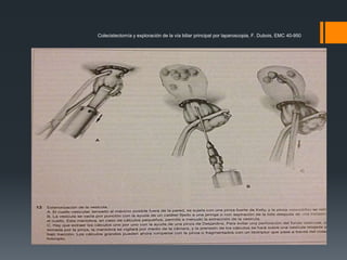 Colecistectomía y exploración de la vía biliar principal por laparoscopia, F. Dubois, EMC 40-950
 