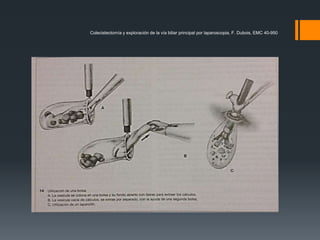 Colecistectomía y exploración de la vía biliar principal por laparoscopia, F. Dubois, EMC 40-950
 