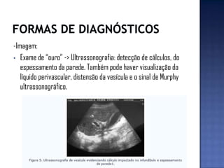 -Imagem:
• Exame de “ouro” -> Ultrassonografia: detecção de cálculos, do
espessamento da parede. Também pode haver visualização do
líquido perivascular, distensão da vesícula e o sinal de Murphy
ultrassonográfico.
 