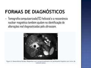 • Tomografia computaorizada(TC) helicoial e a ressonância
nuclear magnética também ajudam na identificação de
alterações mal diagnosticadas pelo ultrassom.
 