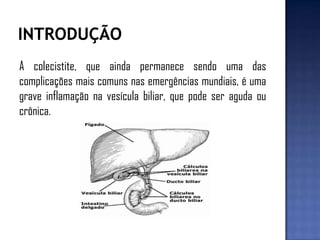 A colecistite, que ainda permanece sendo uma das
complicações mais comuns nas emergências mundiais, é uma
grave inflamação na vesícula biliar, que pode ser aguda ou
crônica.
 
