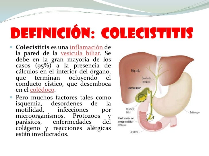 Colecistitis