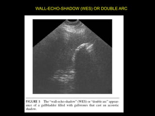 WALL-ECHO-SHADOW (WES) OR DOUBLE ARC
 