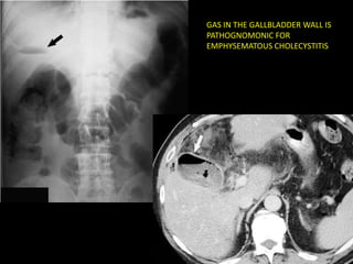 GAS IN THE GALLBLADDER WALL IS
PATHOGNOMONIC FOR
EMPHYSEMATOUS CHOLECYSTITIS
 