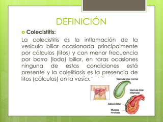 DEFINICIÓN
 Colecistitis:
La colecistitis es la inflamación de la
vesícula biliar ocasionada principalmente
por cálculos (litos) y con menor frecuencia
por barro (lodo) biliar, en raras ocasiones
ninguna de estas condiciones está
presente y la colelitiasis es la presencia de
litos (cálculos) en la vesícula biliar.
 