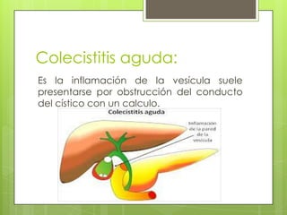 Colecistitis aguda:
Es la inflamación de la vesícula suele
presentarse por obstrucción del conducto
del cístico con un calculo.
 
