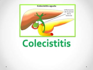 Colecistitis
 
