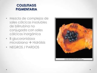 COLECISTITIS AGUDA
• 90-95% Cursan con una colecistitis secundaria a
cálculos biliares
• < 1% son generados por tumores qu...