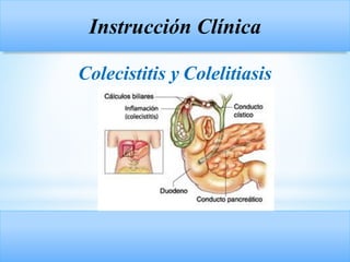 Instrucción Clínica
Colecistitis y Colelitiasis
 