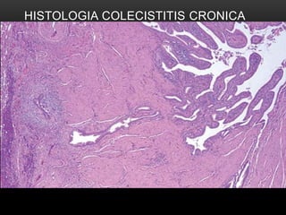 HISTOLOGIA COLECISTITIS CRONICA
 