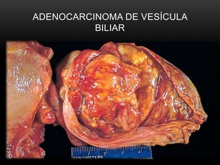 ADENOCARCINOMA DE VESÍCULA
BILIAR
 