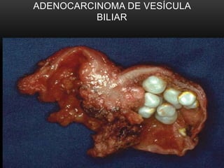 ADENOCARCINOMA DE VESÍCULA
BILIAR
 