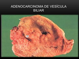 ADENOCARCINOMA DE VESÍCULA
BILIAR
 