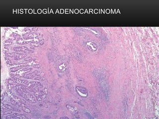 HISTOLOGÍA ADENOCARCINOMA
 