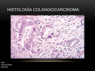 HISTOLOGÍA COLANGIOCARCINOMA
Cell
Estructurales
estroma
 