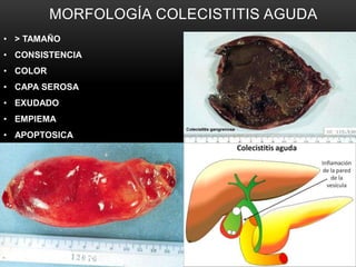 MORFOLOGÍA COLECISTITIS AGUDA
• > TAMAÑO
• CONSISTENCIA
• COLOR
• CAPA SEROSA
• EXUDADO
• EMPIEMA
• APOPTOSICA
 