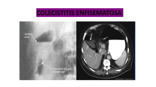 COLECISTITIS ENFISEMATOSA
 