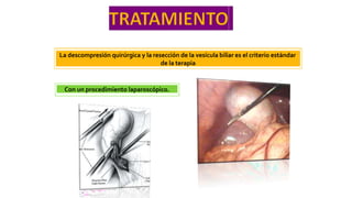 La descompresión quirúrgica y la resección de la vesícula biliar es el criterio estándar
de la terapia
Con un procedimiento laparoscópico.
 
