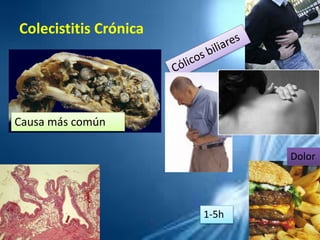 Colecistitis Crónica
Causa más común
Dolor
1-5h
 