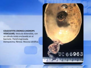 COLECISTITIS CRONICA (HIDROPS
VESICULAR). Vesícula distendida, con
un cálculo mixto enclavado en el
bacinete. Pared engrosada,
blanquecina, fibrosa. Mucosa atrófica.
 